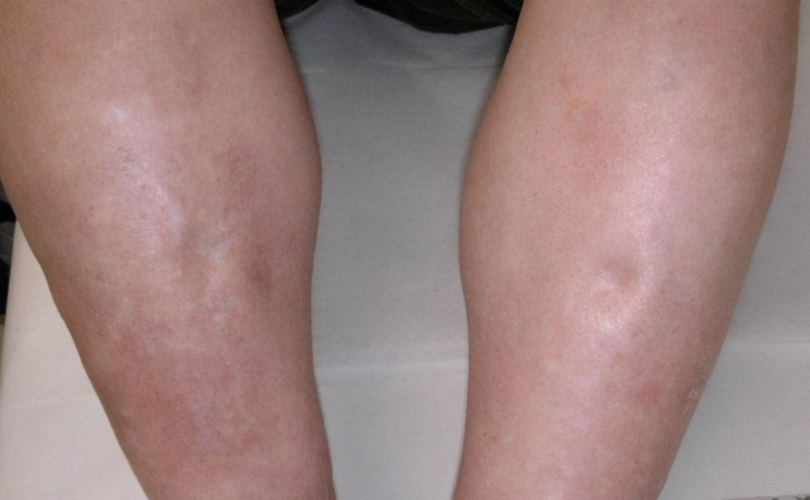 中晚期 糖尿病 肾病 出现下肢明显浮肿