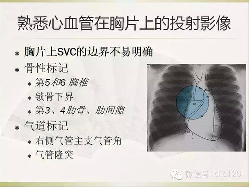 picc导管头端定位与并发症处理