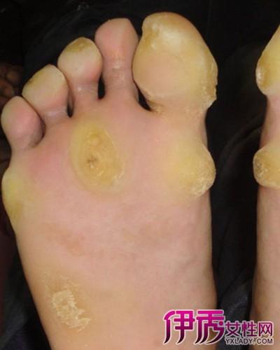 【图】脚垫怎么去除小窍门 教你如何快速去除脚垫重获轻松