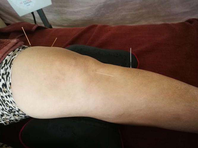 李氏三针传承人李东医生,针灸治疗颈椎病,腰,腿疼,一次见效,一到两个