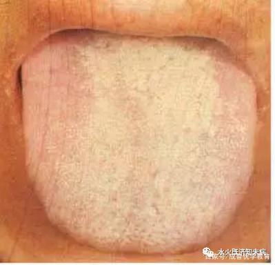 (二十四),黑燥苔胃癌患者临终前二天,舌苔黑而燥裂,根部黑苔长如黑毛