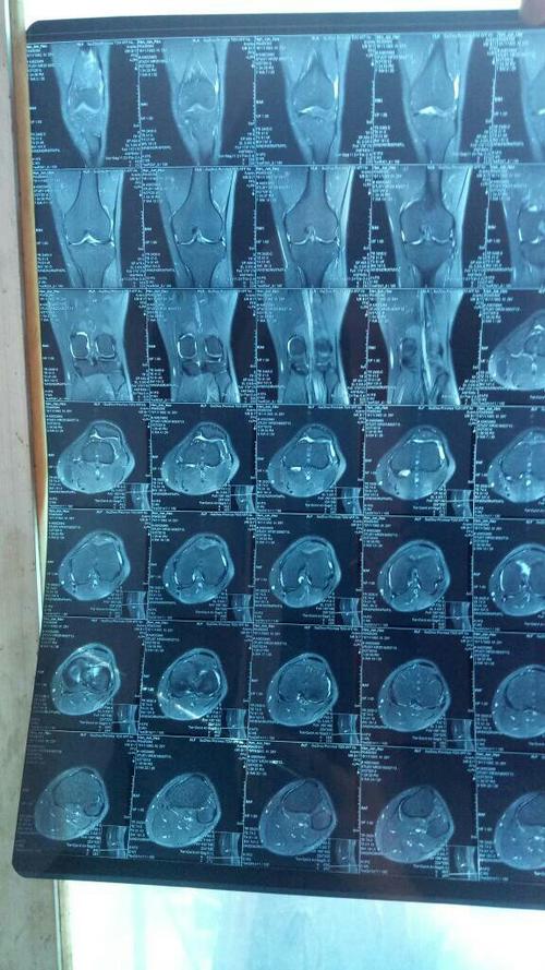 哪位老医生会看膝关节的核磁,两个医院说半月板损伤 韧带拉伤, 有一个