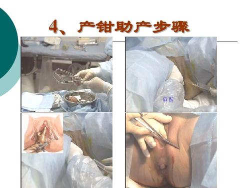 产钳助产术ppt