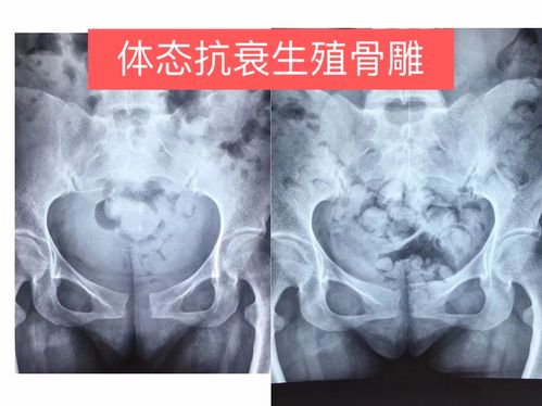 体态抗衰生殖骨雕介绍
