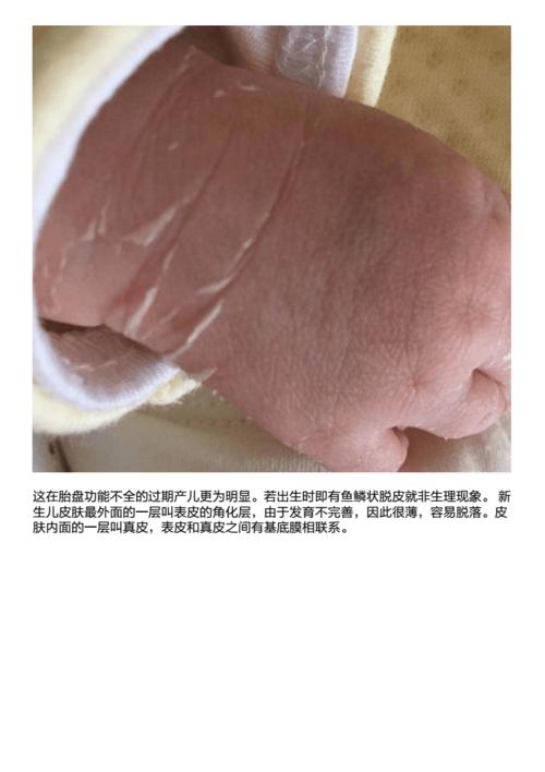 新生儿为什么会脱皮,什么时候开始脱皮,胎皮多久会脱完?pdf