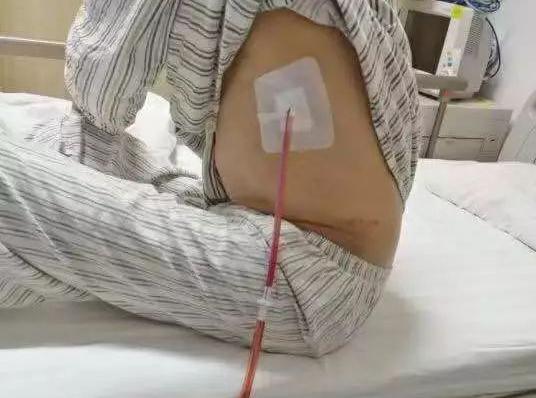 手术后,留了胸腔引流管,这管子有什么作用?医生再三叮嘱要注意