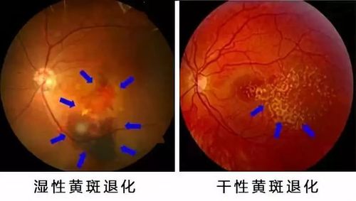 年龄相关性黄斑变性,也称老年性黄斑变性,英文简写为amd.