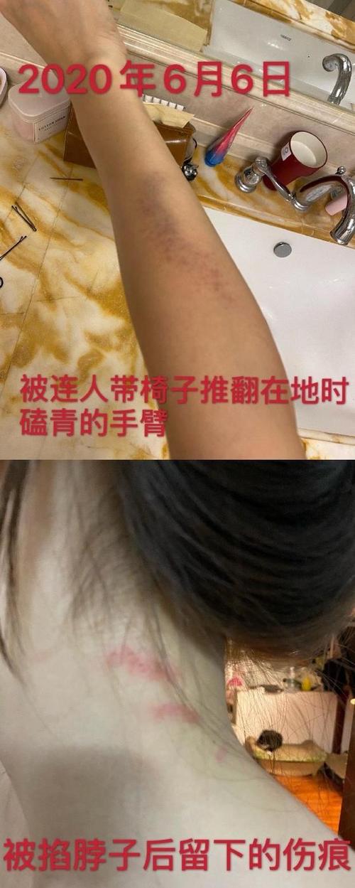 组图:张培萌妻子晒被家暴图 指甲破裂腿部淤青
