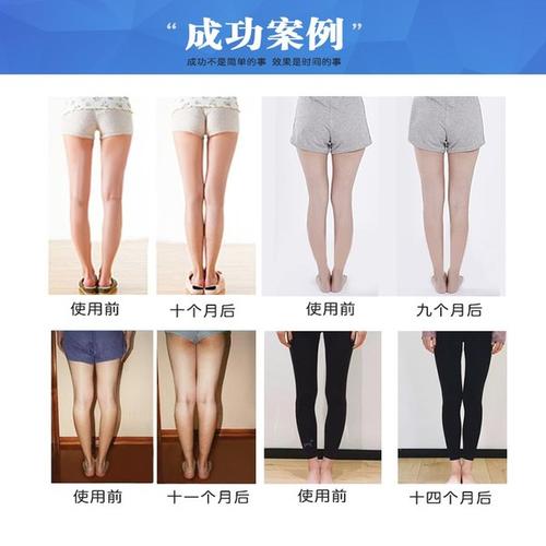 购客儿童足内翻膝内翻x腿o型腿矫正鞋 垫胫骨内旋内八字外八字矫正器