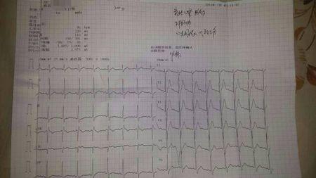 前两天心绞痛,去医院做了个心电图,医生说没事.想请医生仔细讲解讲解