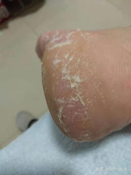 又称鳞屑角化型脚气,表现
