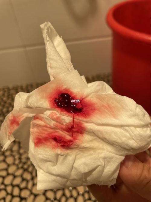 药流第十天,今天复查还有稍高回声2.3x1.3cm残留,每天