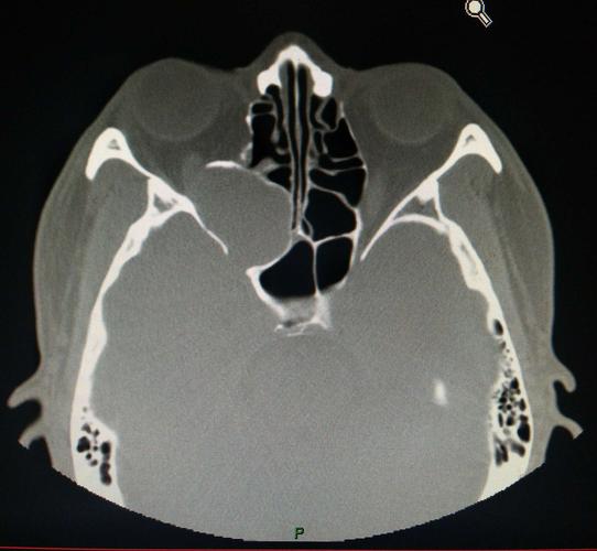 行眼眶ct回示:巨大筛窦囊肿,侵及眼眶及视神经.