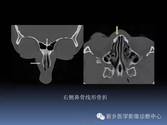 写鼻骨骨折ct报告,一定要了解的解剖