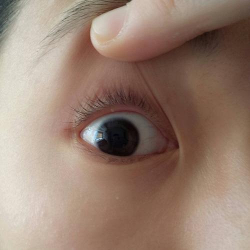 今天早上起来发现眼睫毛的下方长了一小粒东西,感觉是水泡,很担心啊
