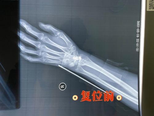 南山滑雪手腕桡骨远端骨折日记1_滑雪_骨折_医疗健康