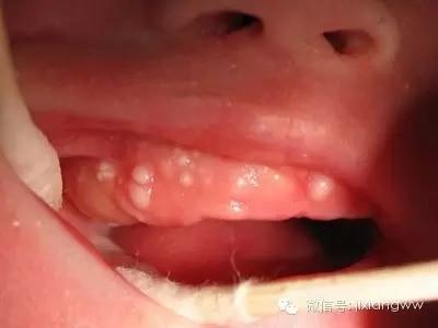 宝宝口腔状况多 当妈的都要懂