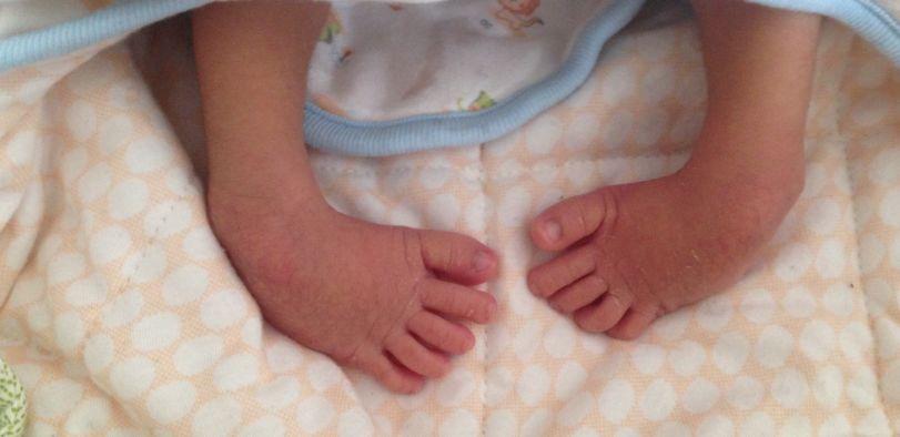 新生儿足内翻是自然现象吗?要不要治疗?