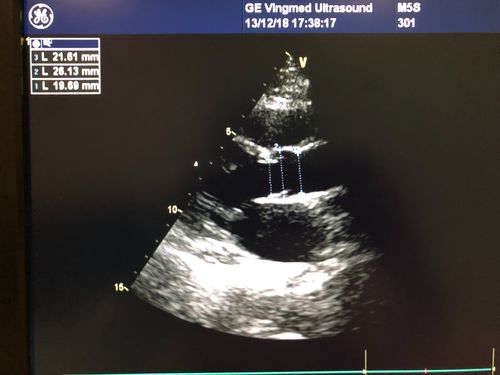 主动脉瓣环,窦部,窦管交界处测量