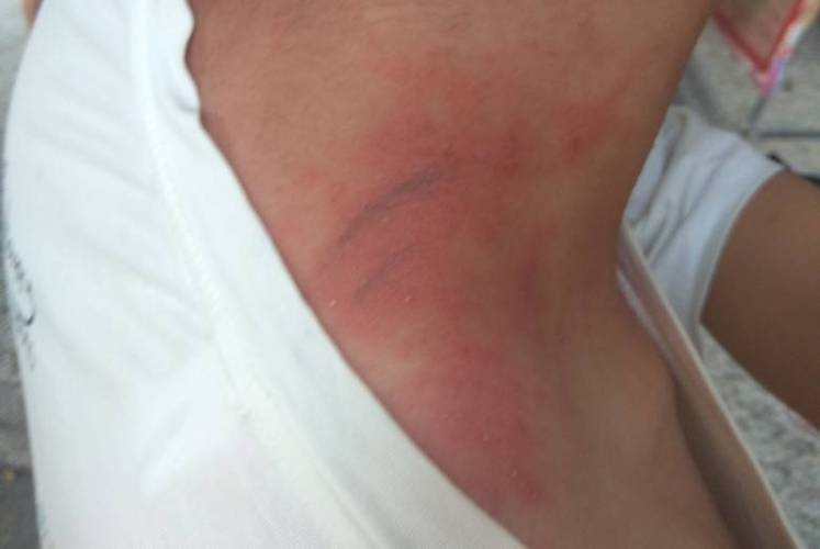 这是不是被蜈蚣爬过?还是被什么虫子咬了?