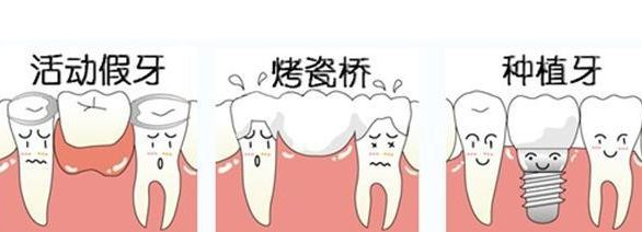 牙齿缺失选择哪种镶牙方式比较好?