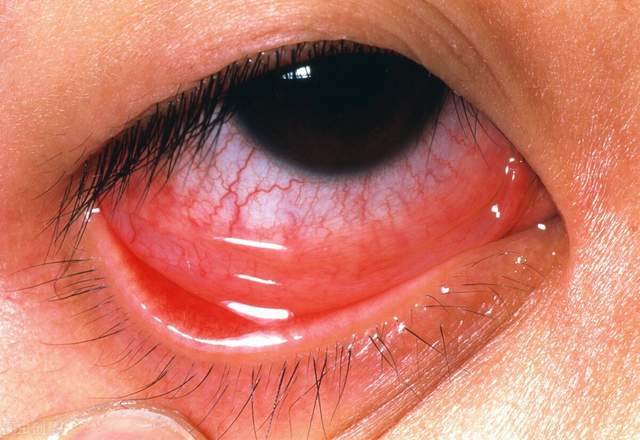 更严重时造成眼干燥,角膜全部混浊而失明. 症状 轻度患者眼