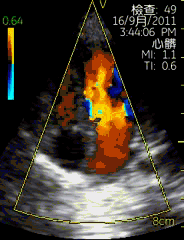 vscan临床图片 心脏