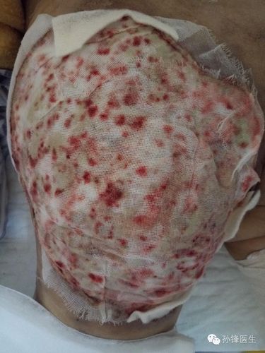 (图文)手把手教你做手术:臀部化脓性汗腺炎病灶切除