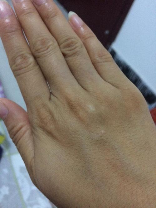 请问我手上这白点点是病吗,求赐教