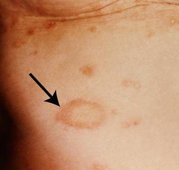 多方面的介绍下玫瑰糠疹