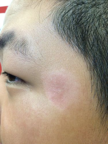 脸上有一块皮肤脱皮,发红,比较干,是晒伤吗?