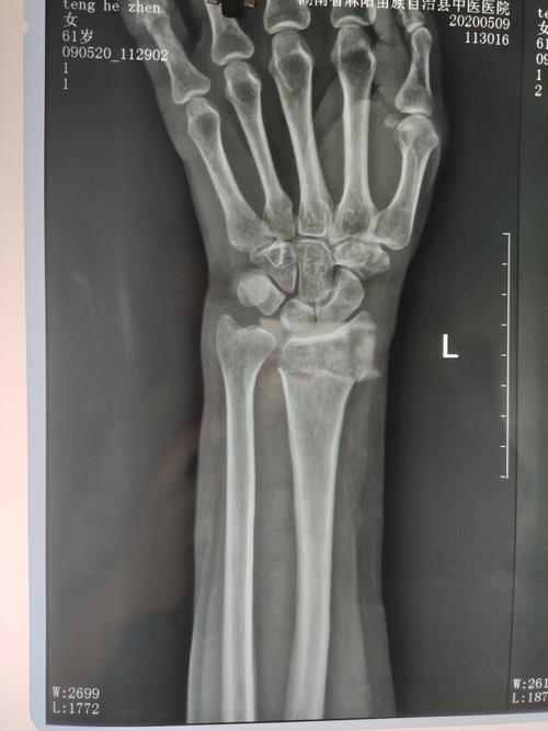 桡骨远端骨折中医正骨有妙招