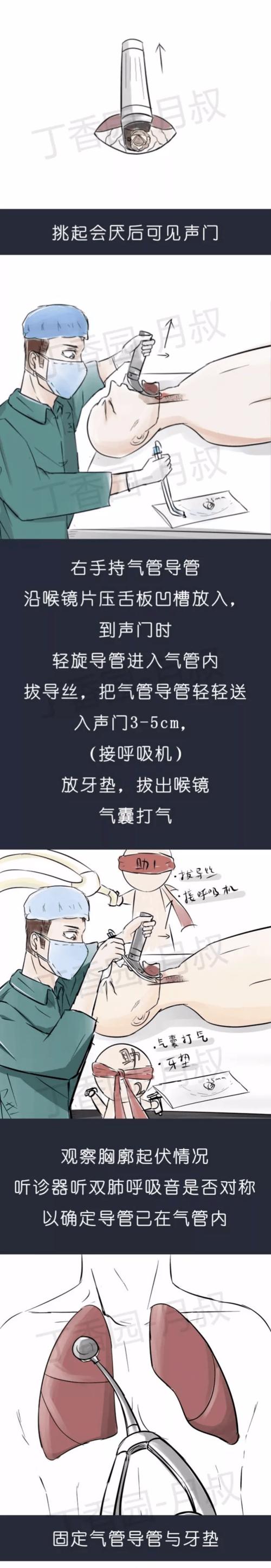 气管插管相关知识用漫画视频讲的很清楚