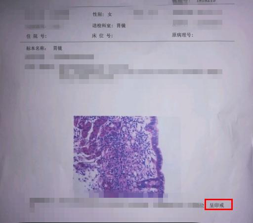 80后女子最近总是感到胃胀胃不适检查结果让她差点崩溃