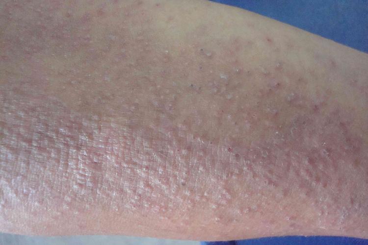 这是不是神经性皮炎