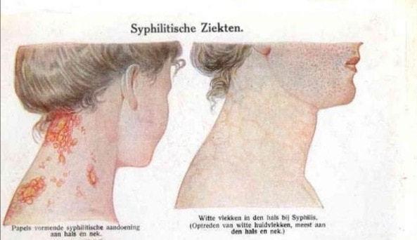 梅毒有多可怕性世界的恶魔诅咒我们是否能够彻底摆脱它