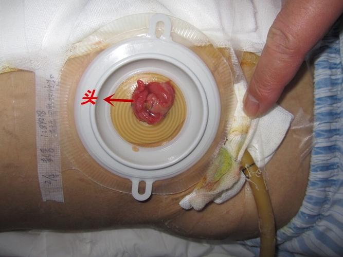 5)粘贴2件式凸面底盘14249 1698型开口肠造口袋,更换频次为每天一次