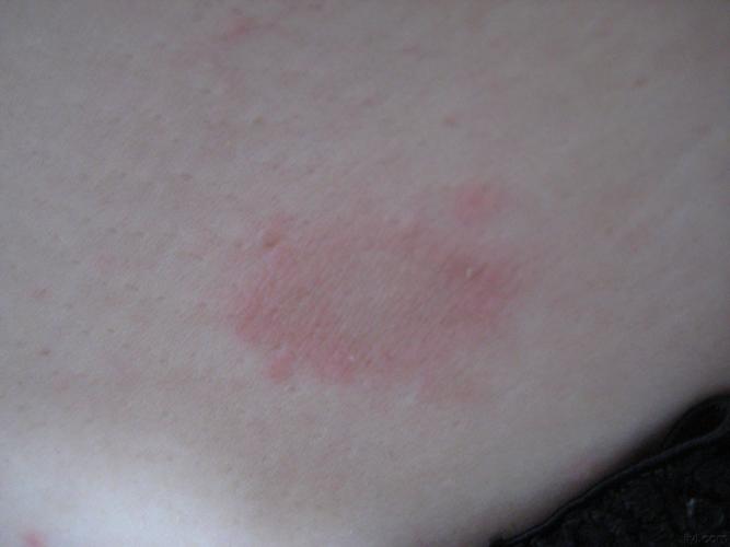 水疱型玫瑰糠疹