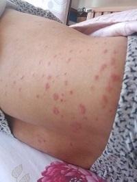 皮肤湿疹,反反复复 怎么办?