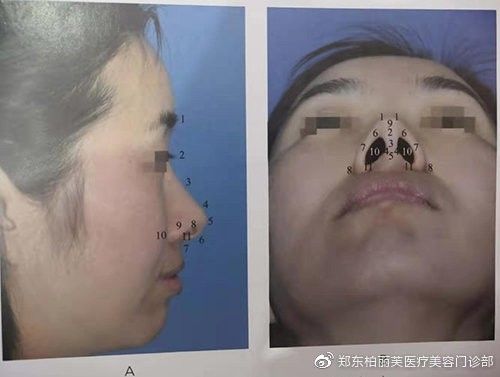 2,鼻根点(鼻额交界点):额骨和鼻骨的交界点 3,鼻缝点(骨-软骨交界点)