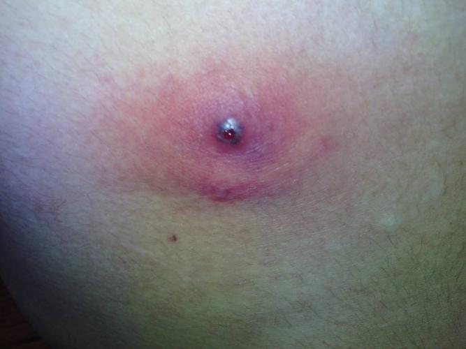 胸口长了个毒疮 挤了后还是肿 怎么办啊 是不是还没挤干净 可疼