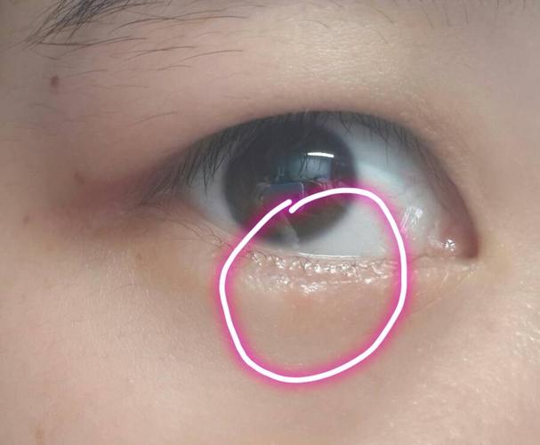 右眼下眼睫毛下面长了个有点红红的小肉粒,不痛不痒,照片照起来没那么