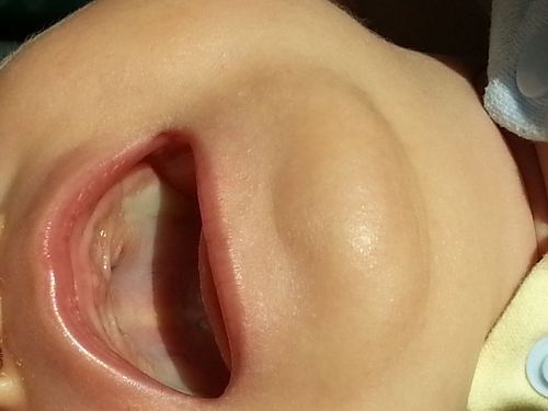 仔细看了口腔,上腭部位发白(如图,尤其指的是上腭正中部位,牙床部