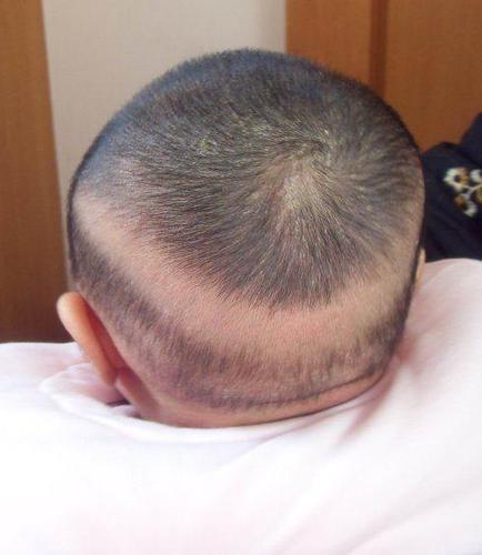 初哆咪宝宝的后脑勺没有头发