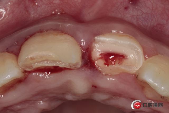 看一下颌面,11没有露髓,21牙髓暴露