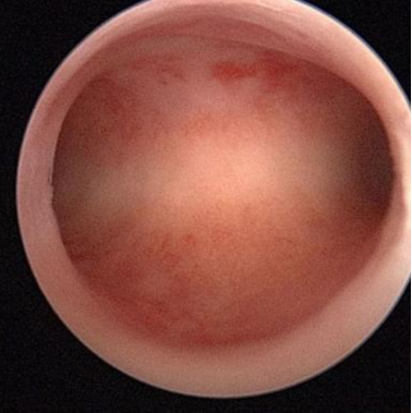 正常宫颈图像宫腔镜可以发现宫颈管及宫腔内的各种异常,包括宫颈,宫腔