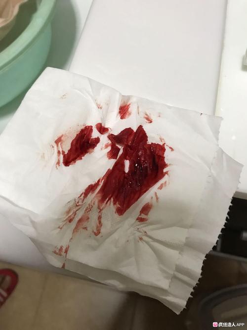 [试管婴儿]8周6天有出血,带血图慎入