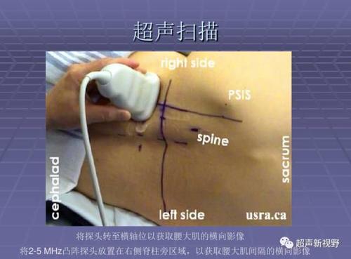 超声引导小儿阴茎背神经阻滞ppt课件