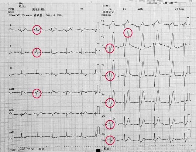 仅凭心电图到底能不能确诊冠心病到底怎样才能确诊冠心病