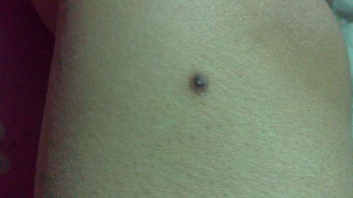 腿上长了3个这样的疙瘩,前几年是毛孔有黑点 有手扣过